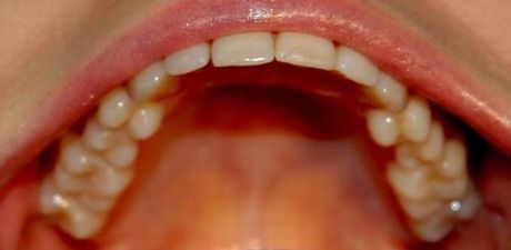 I munden symptomer kræft TUNGEKRæFT: SYMPTOMER,